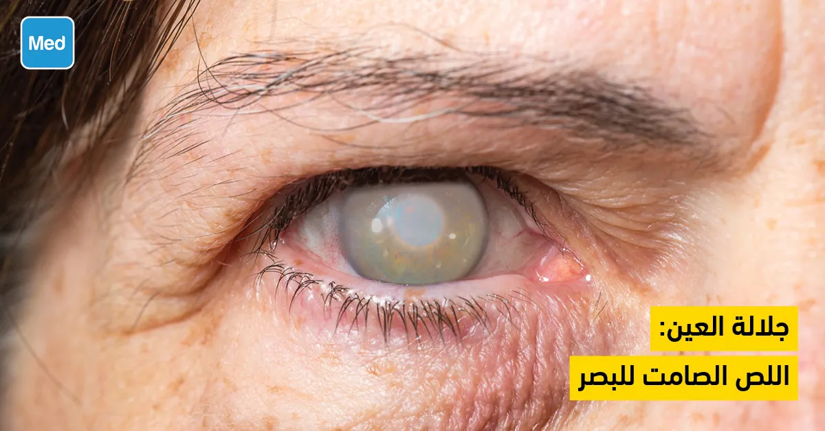 جلالة العين: اللص الصامت للبصر